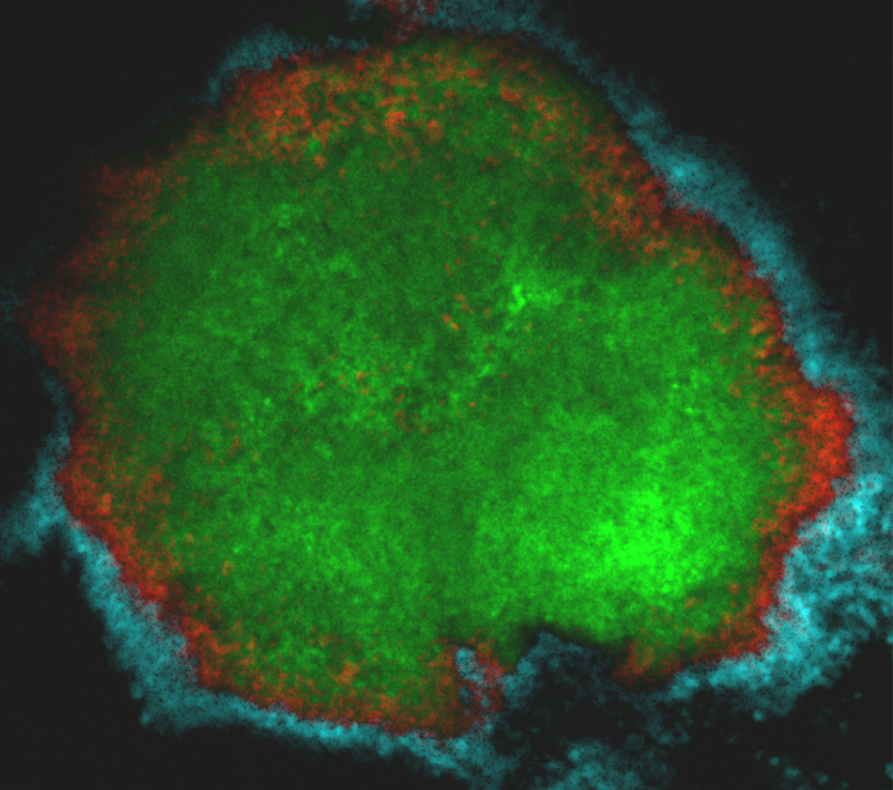 With powerful microscopy, researchers were able to visualize the structure of a tooth decay-causing biofilm growing on toddlers’ teeth. The organism primarily responsible for cavities, Streptococcus mutans, labeled in green, shields itself under layers of