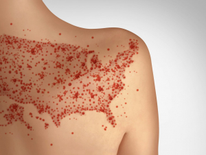 Measles infections send 1 in 5 people to the hospital. Measles infections send 1 in 5 people to the hospital.
